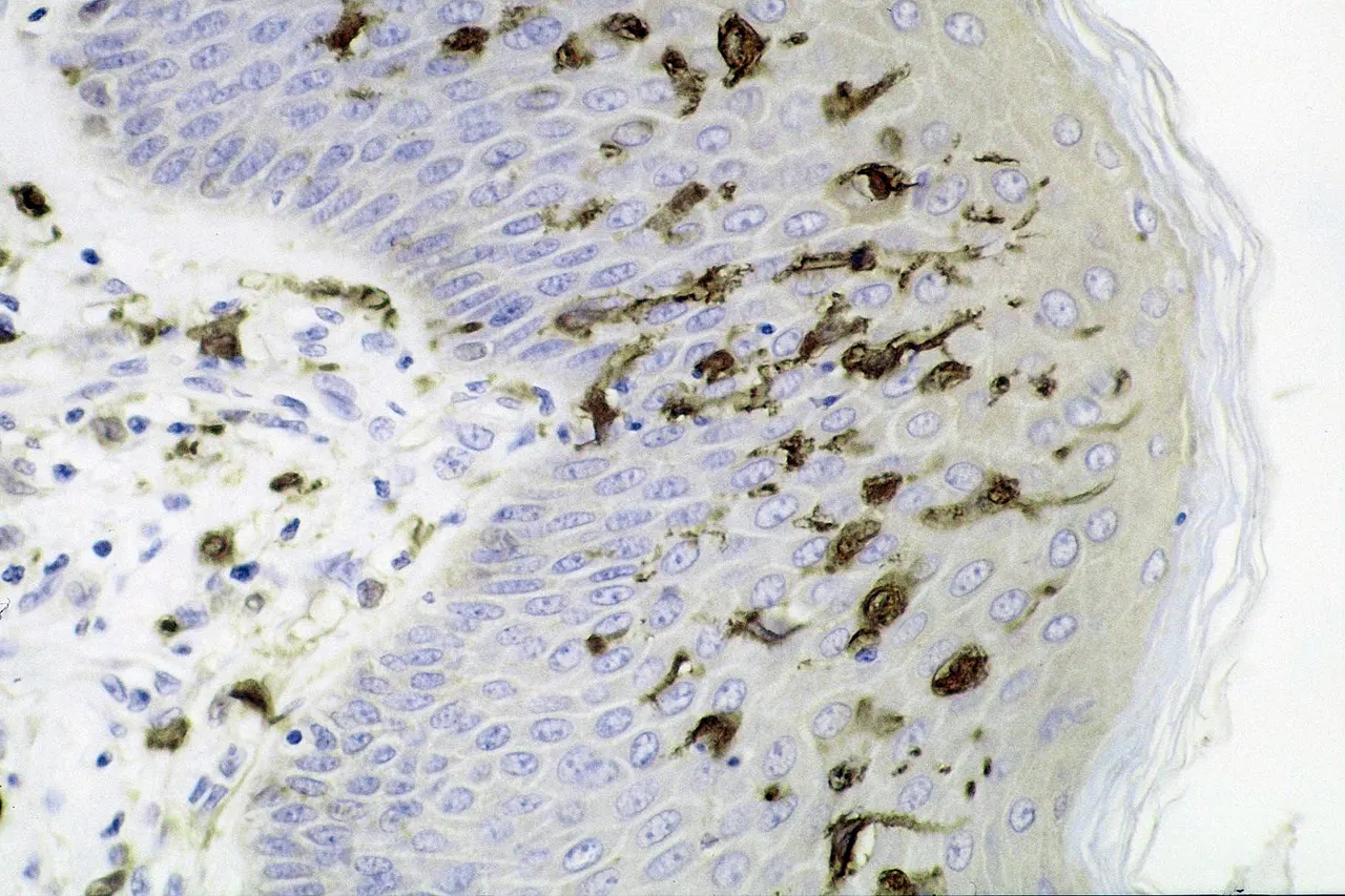 Section of skin showing large numbers of dendritic (Langerhans) cells in the epidermis. Mycobacterium ulcerans infection, S100 immunoperoxidase stain.