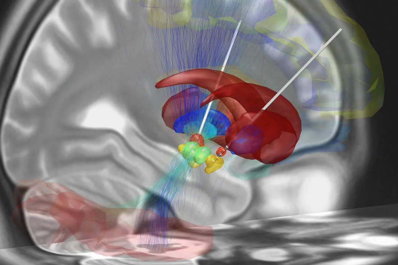 Depicted is a reconstruction of bihemispheric DBS electrodes that have been surgically placed into the most common target structure for treatment of Parkinson's Disease, the subthalamic nucleus (orange). Other subcortical structures include the red nucleus (green), the substantia nigra (yellow), the internal (cyan) and external (blue) pallidum and the striatum (red). A stimulation volume is modeled by applying 2V (at 1000Ω impedance) to the second-uppermost contact of the left electrode. Structural fibertracts traversing through this volume are visualized and cortical regions that they connect with the stimulation volume are selected from an automatic anatomical labeling atlas and visualized. Picture created using LEAD DBS software (www.lead-dbs.org)